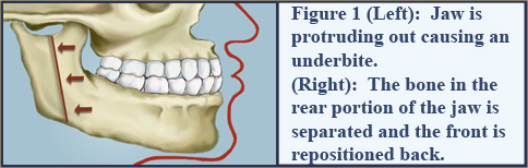 Jaw is protruding out causing an underbite.