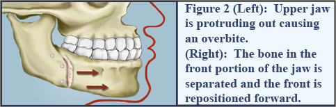 The bone in the rear portion of the jaw is separated and the front is repositioned back.