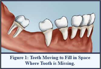 Figure 1:Teeth Moving to Fill in Space Where Tooth is Missing