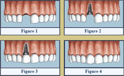 Dental Implants Figures