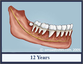 wisdomTooth_12years