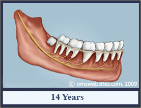 wisdomTooth_14years