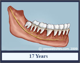 wisdomTooth_17years